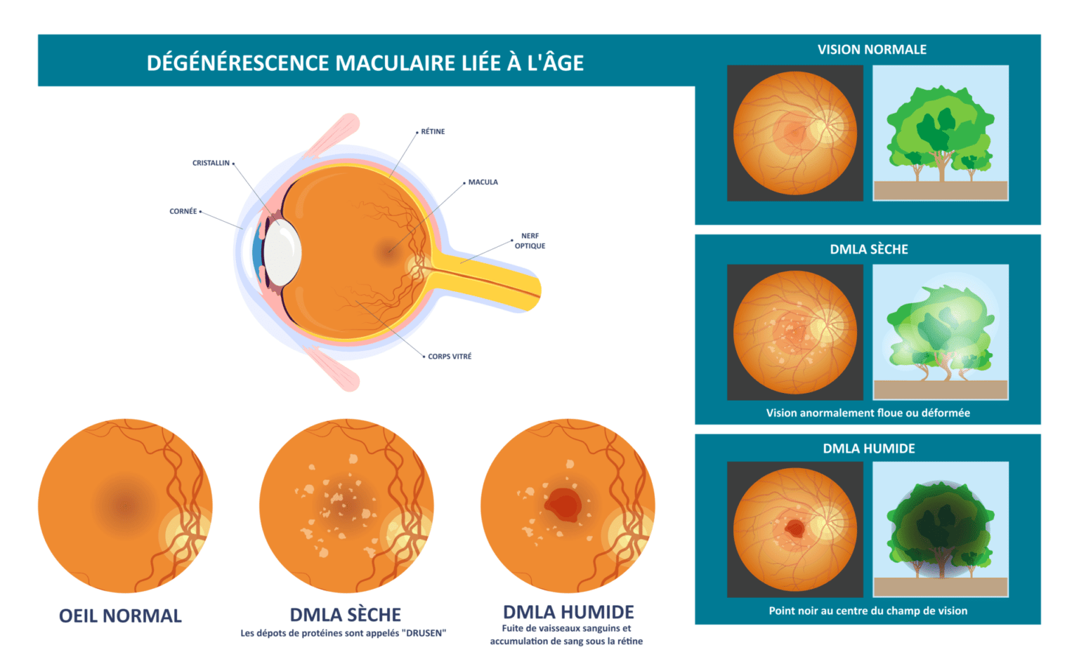 Dmla Ophtamaine Le Mans