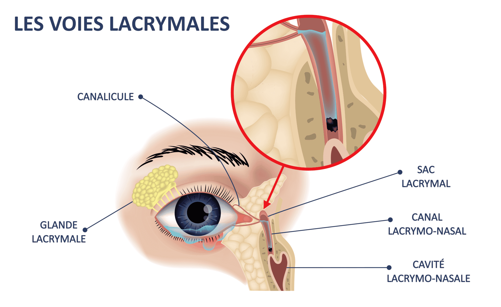 Obstruction des voies lacrymales